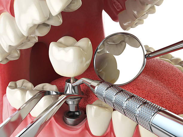 Best Emergency Root Canal Treatment in Ashland, AL